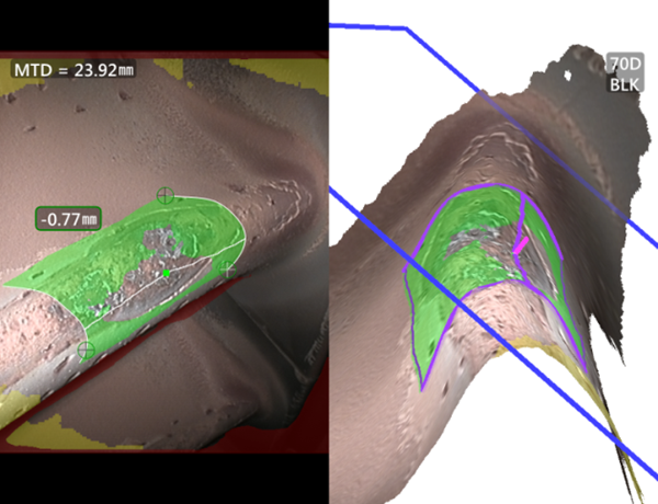 使用三維測(cè)量工業(yè)內(nèi)窺鏡測(cè)量凹坑深度 使用三維測(cè)量工業(yè)內(nèi)窺鏡測(cè)量凹坑深度